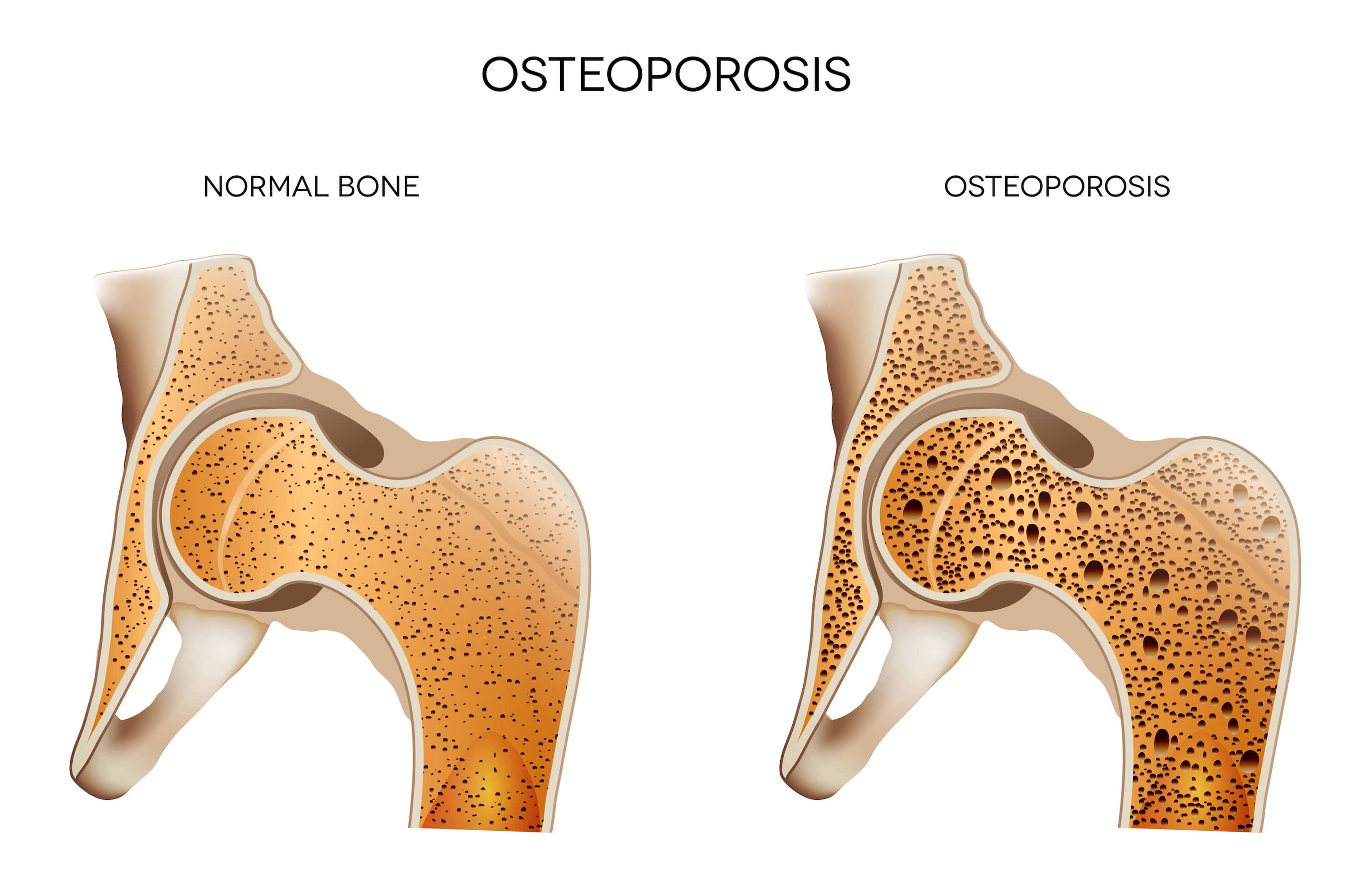 osteoporos